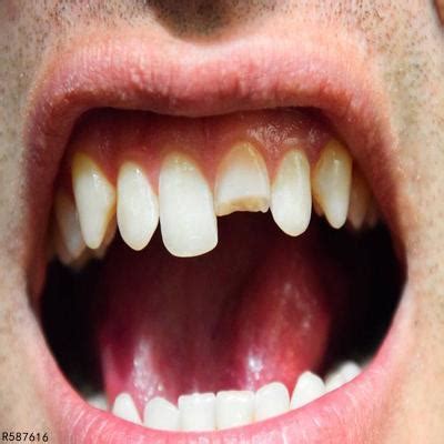 门牙出现蛀牙的原因是什么 门牙上长个蛀牙怎么办_蛀牙_快速问医生