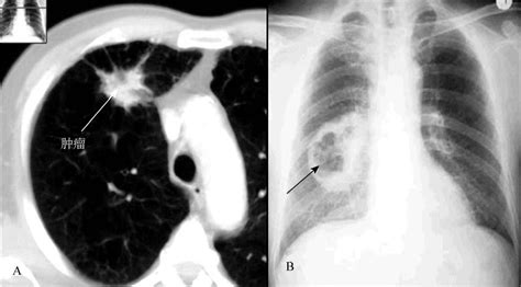 三、影像学检查进行早期筛查与诊断-肺癌诊断与治疗-医学