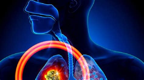 肺癌临终征兆 肺癌晚期死前症状有哪些_中华康网