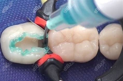 观音桥哪家牙科便宜:重庆牙卫士口腔医院矫正,种植牙都不贵,种植牙-8682赴韩整形网