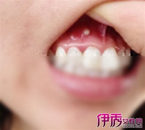 小脓包图片