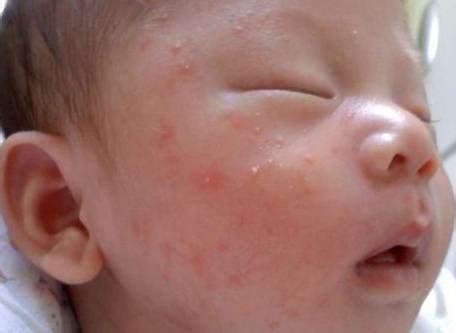婴儿身上起红疹（孩子出生长红疹是什么原因）-幼儿百科-魔术铺
