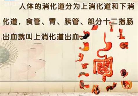 上消化道出血 的图像结果