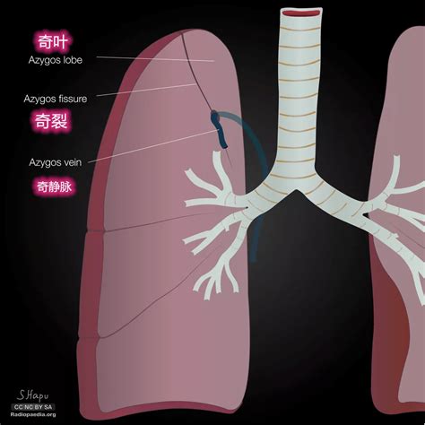 多出来的肺裂，你认识几个？_右肺