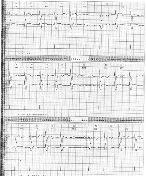 心电图图例分析：双腔起搏器DDD及VAT起搏模式 - 爱爱医医学网
