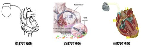世界最小的心脏起搏器，你知道吗？——上海市胸科医院起搏团队带您了解 -- 严道脑血管网