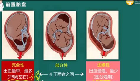 【2023临床医师专业解读】病理妊娠中胎盘早剥、前置胎盘的鉴别