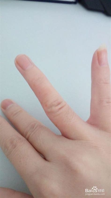 【手指上起小水泡】【图】手指上起小水泡是怎么回事？ 5种方法有效治疗小水泡(3)_伊秀健康|yxlady.com