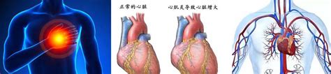 CMR对肥厚型心肌病的鉴别诊断_心脏