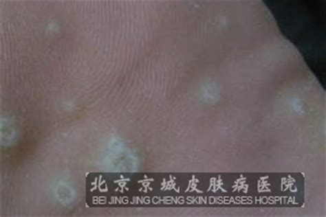 治疗跖疣的方法都有哪些_跖疣_北京京城皮肤医院(北京医保定点机构)