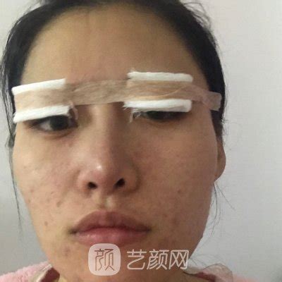 上海九院朱惠敏医生双眼皮修复案例展示|效果自然美观_艺颜网