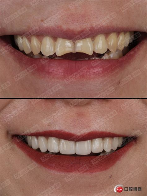 两例前牙美学修复-潘海桃的博客-KQ88口腔博客