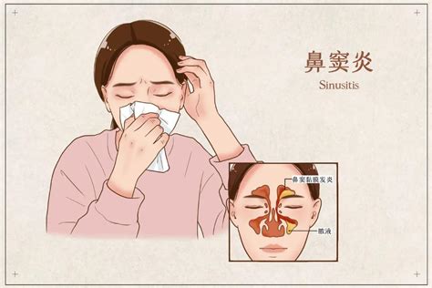 中医怎么治疗鼻炎效果好？