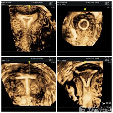 妇科超声利器！超声医学科专家：经阴道三维彩超 精准诊断妇科疾病 - 全程导医网