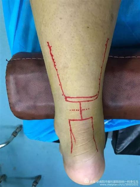南阳市骨科医院：3cm的切口！微跟通技术治疗跟腱断裂