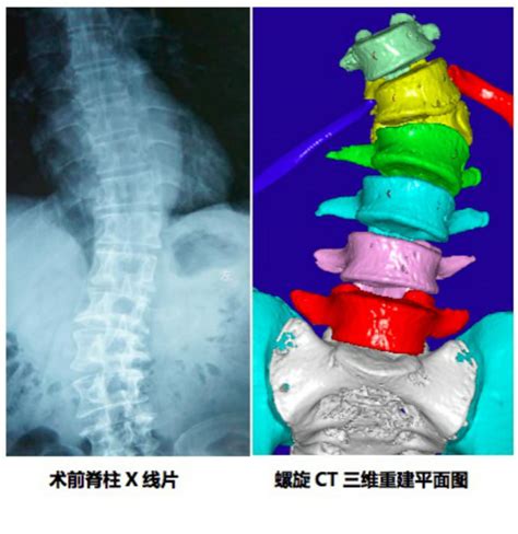 脊柱检查之X线、CT、MRI影像解剖 - 好医术早读文章 - 好医术-赋能医生守护生命