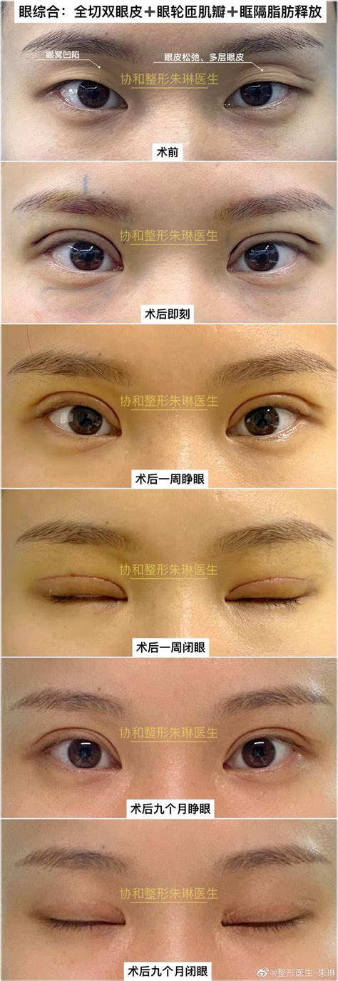 北京双眼皮修复 眶隔脂肪释放上睑凹陷矫正 提肌微调手术 - 知乎