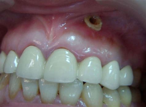 【牙龈长包怎么回事】【图】牙龈长包怎么回事呢 教你如何拥有健康牙龈(2)_伊秀健康|yxlady.com