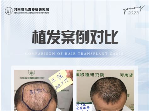 头发种植的步骤及术后注意事项_上海美莱医疗美容