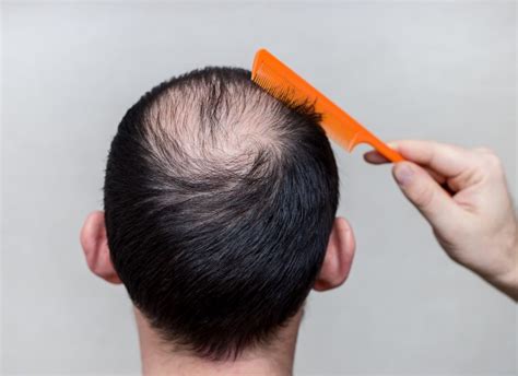 脱发为何多从头顶开始头顶头发稀少的原因是什么 - 知乎