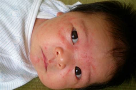荨麻疹，药吃了3个月，还是反复发作_凤凰网健康_凤凰网