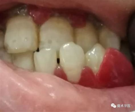 牙周炎——中国成年人后半生永远的痛|牙周炎|中国|永远|牙菌斑 ...
