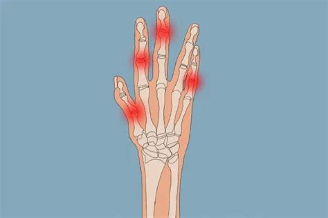 双手无名指关节对称疼，手握拳无力无名指关节痛是什么原因