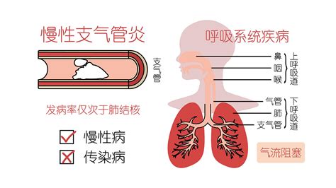 肺腑之言：慢性支气管炎发病率仅次于肺结核，不可小视_解渴果-站酷ZCOOL