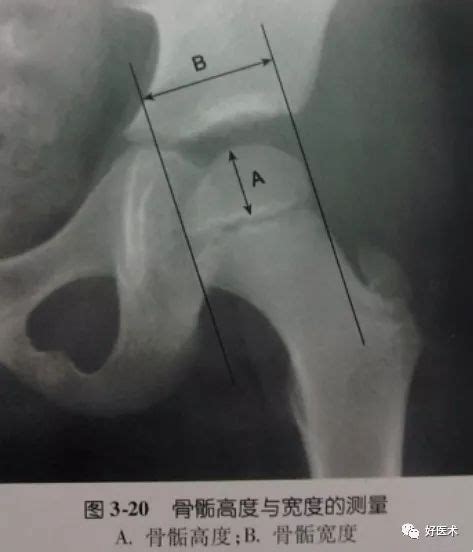 测量骨盆演示图图片