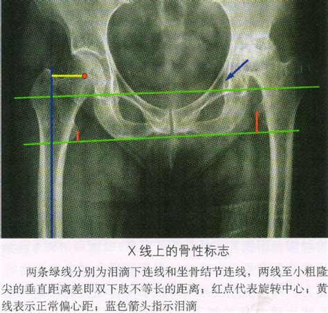 骨小梁示意图图片