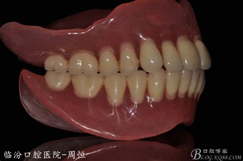 益美活动义齿系列 - 陕西精益齿科技术有限公司