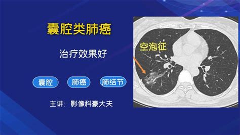杭州52岁男子肺癌晚期!这几个症状耽误了半年,自以为年轻很健康...医生:40岁之后这件事很要紧 - 封面新闻