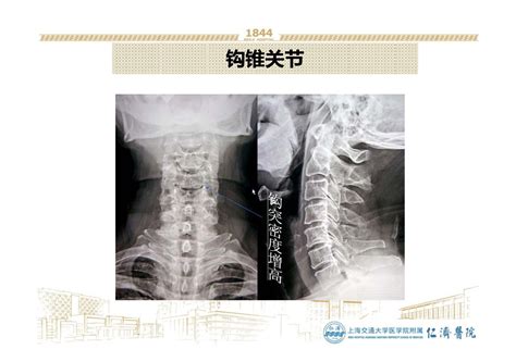 钩椎关节解剖图图片
