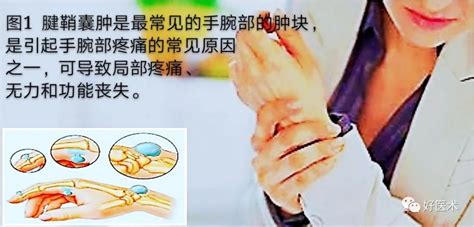 手背腱鞘囊肿图片