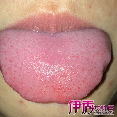 【舌头起红点是怎么回事】【图】揭秘舌头起红点是怎么回事 3个方面告诉你舌头红点的原因(3)_伊秀健康|yxlady.com
