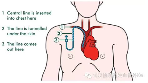 中心静脉置管（PICC）常见并发症及预防_水滴健康_水滴筹