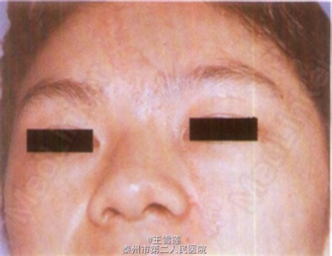 汗孔角化症图片