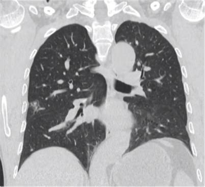 另类肺结节——空洞型肺癌 | 中山大学附属第八医院