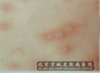 带状疱疹一般的症状有哪些_带状疱疹_北京京城皮肤医院(北京医保定点机构)