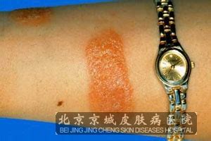 导致接触性皮炎的原因是哪些_接触性皮炎_北京京城皮肤医院(北京医保定点机构)