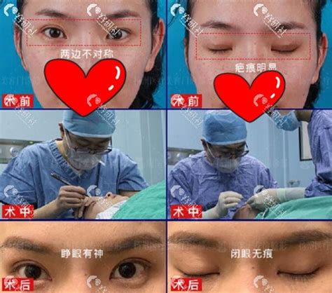 北京美容院割双眼皮多少钱-城市惠整形