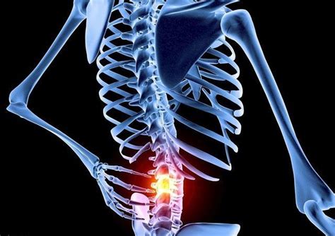 腰间盘突出的图片