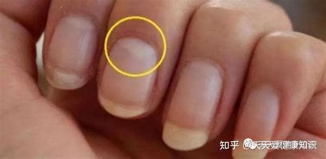 娃指甲上的月牙、白点、横纹、竖纹，都预示着啥疾病？看完这篇就明白了！__小豆苗疫苗助手