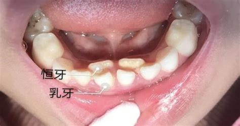 乳牙早期萌出异常问题（一）-京东健康