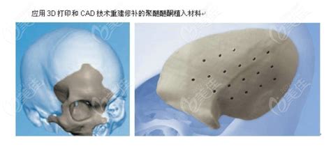 下颌角切多了缺损补骨成功实例:3d打印人工骨技术价格也有,颌面对比照-8682赴韩整形网