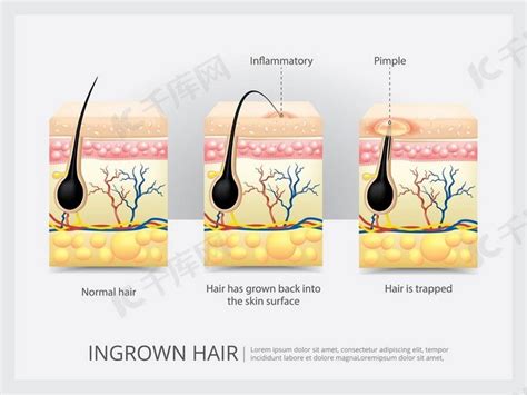 头发增长周期插图解剖图发展头发毛囊从生长png下载-包图网