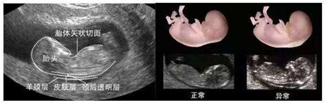 连载（九）|圆圈妈双胞胎怀孕过程第12周 - 知乎