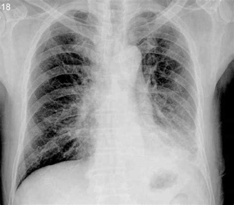肺脓肿吸收后索条影-特种医学-医学