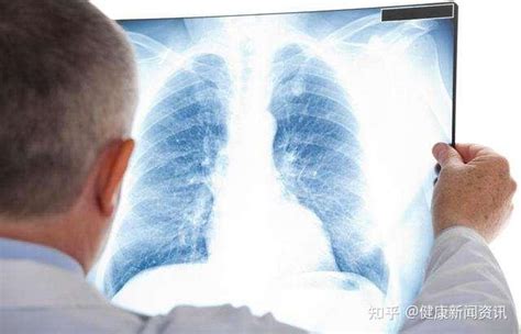 肺癌可分为哪几种呢？ - 知乎