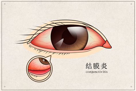 角膜炎图片